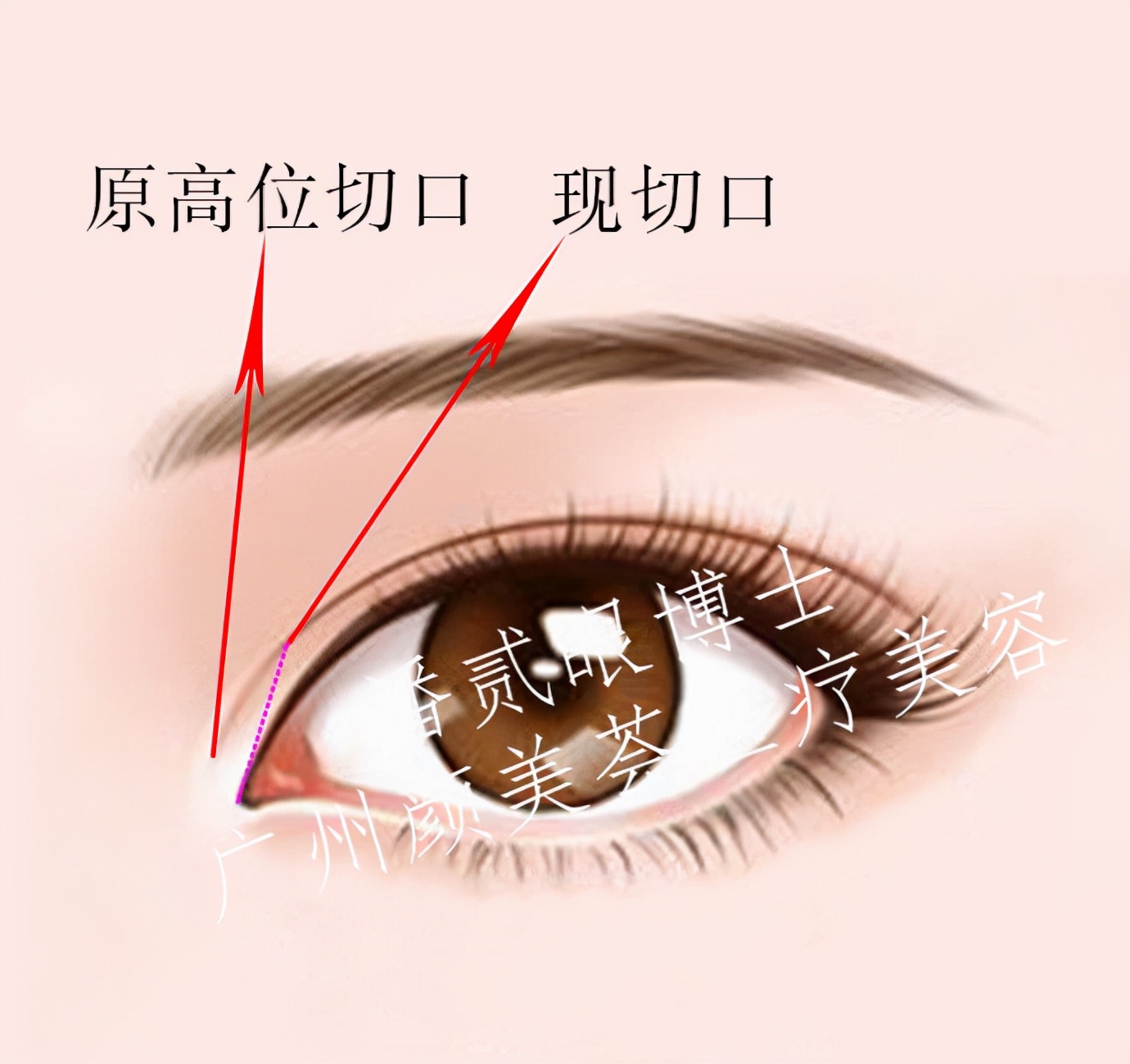 双眼皮修复脂肪填充成活率高吗,全脸脂肪填充跟双眼皮怎么一起做