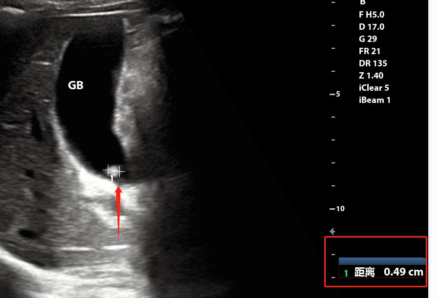 超声所见正常范围准确吗,超声看不清楚