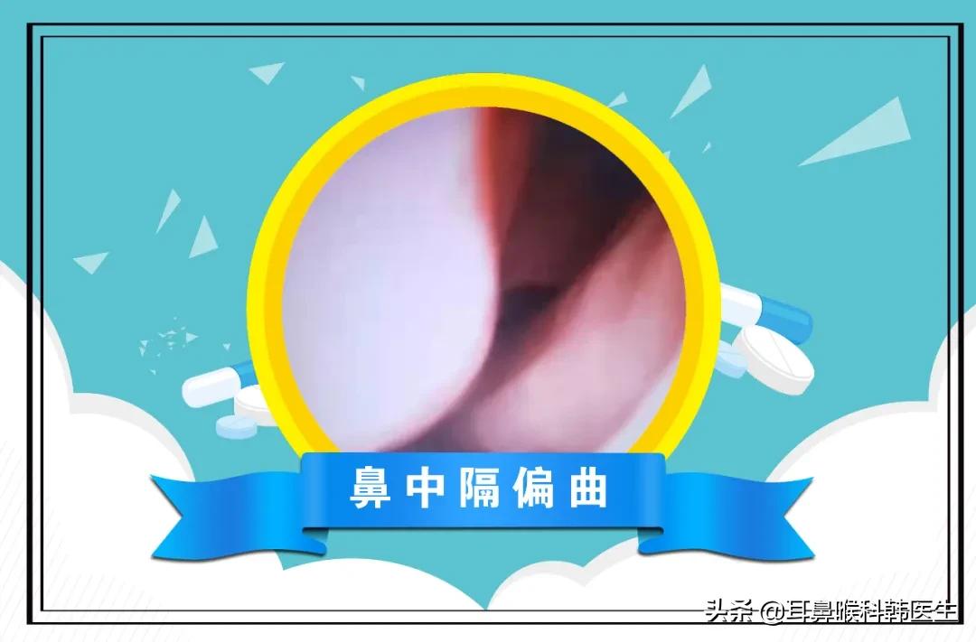 耳鼻喉科电子内窥镜能检查什么病,耳鼻喉内窥镜详细操作流程考核表