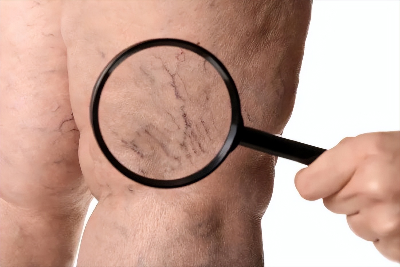 腿部青紫且疼怎么回事,腿上出现青紫筋咋回事