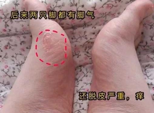 日本人如何处理脚气问题,欧美人为什么更容易患脚气