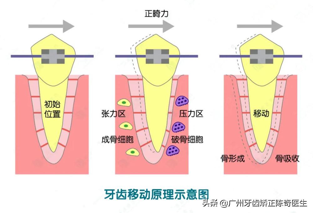 不想戴牙套用什么办法矫正,牙齿正畸后没佩戴保持器反弹