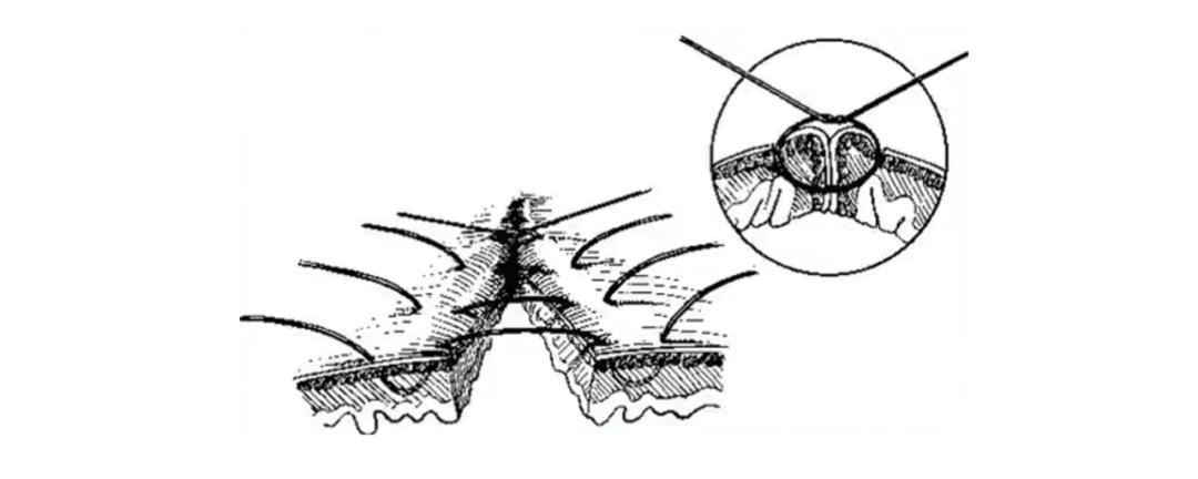外科缝合技巧你熟练吗,外科缝合术的操作步骤