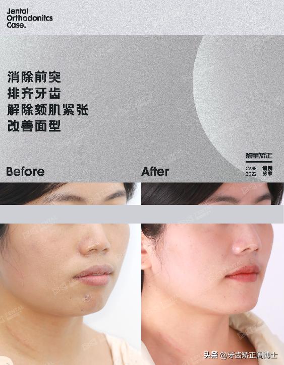 闭嘴巴下巴有核桃纹做什么手术,为什么下巴会有像核桃一样的纹路