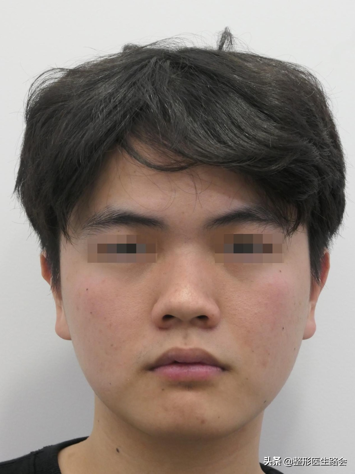 24岁小伙子隆鼻,隆鼻手术效果图解对比照