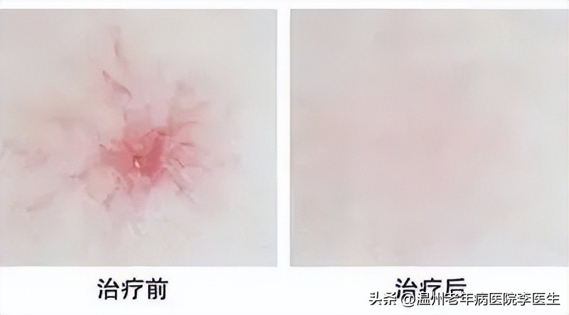 光子嫩肤真的嫩肤吗,美白嫩肤光子