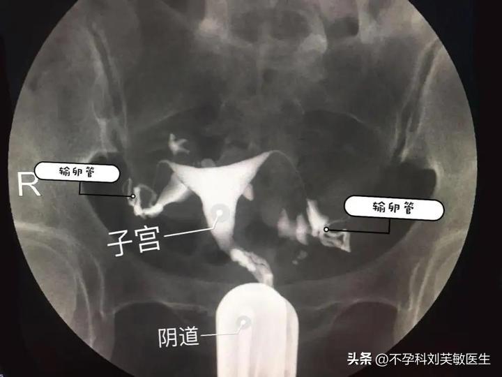 输卵管造影步骤图片解读,如何看懂输卵管造影片子