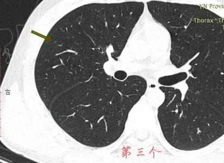 因癌症去世的妈妈,母亲肺癌子女查出磨玻璃结节