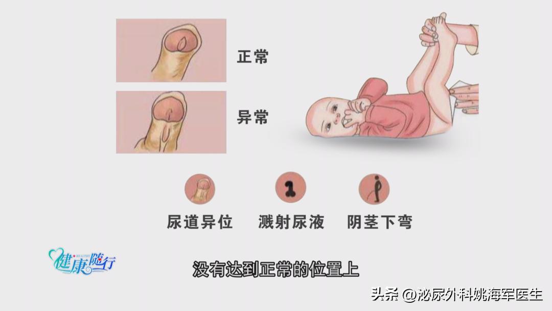 尿道下裂症有哪些症状,尿道下裂有何症状表现