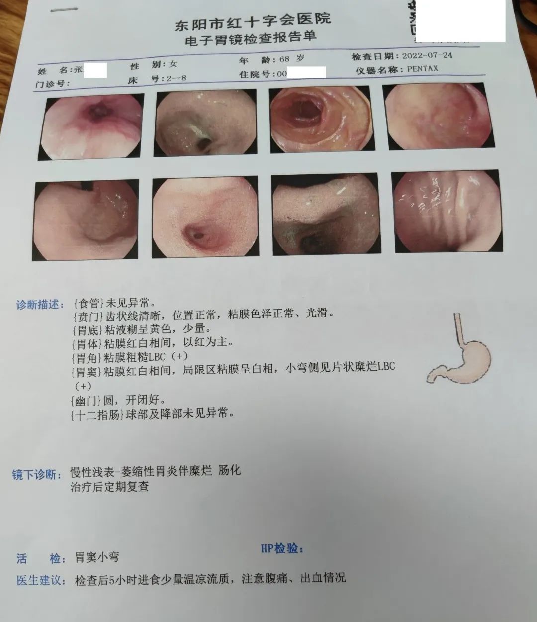 肠化调理中医,中医治疗中度肠化逆转案例