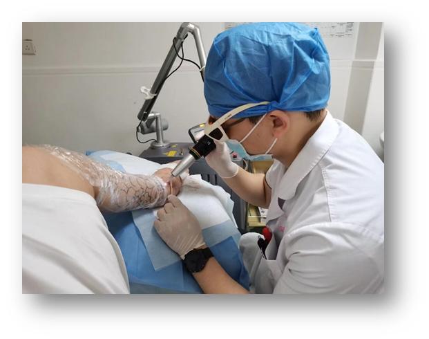 激光清洗的误区,洗纹身五大误区照片