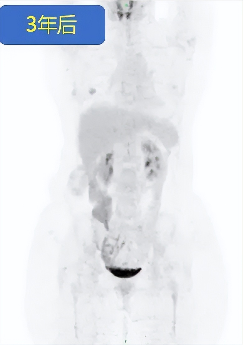 卵巢癌出现肠梗阻怎么治疗,卵巢癌晚期肠梗阻怎么治疗