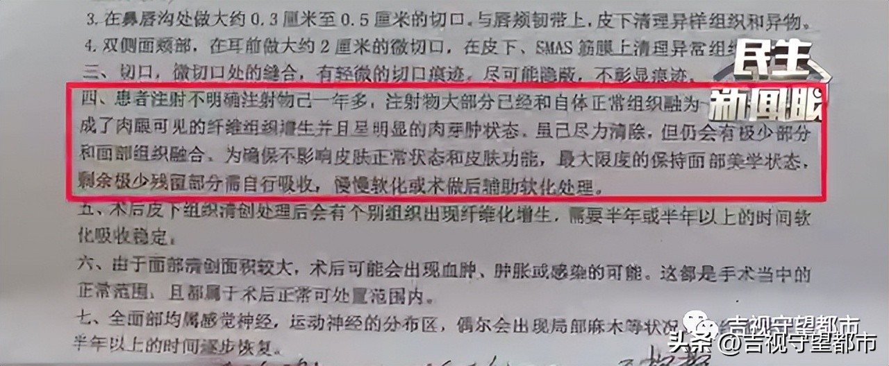 做完填充1年水肿,面部取出填充物手术