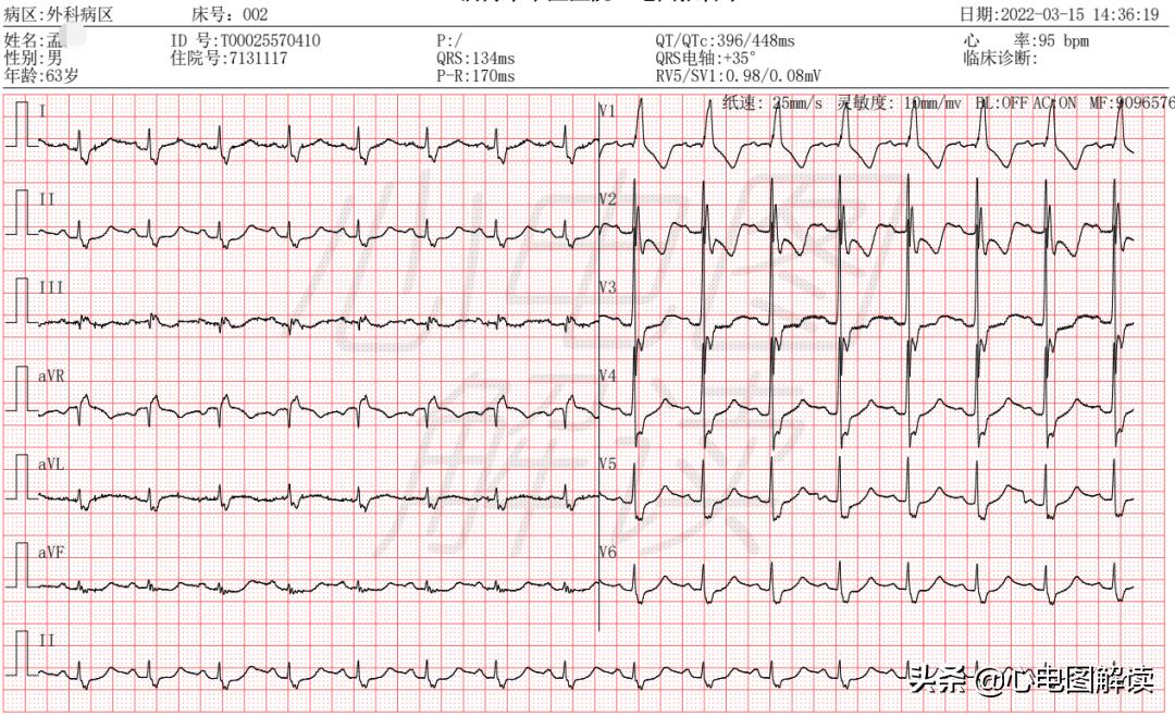 右束支阻滞训练方法,右束支阻滞自愈