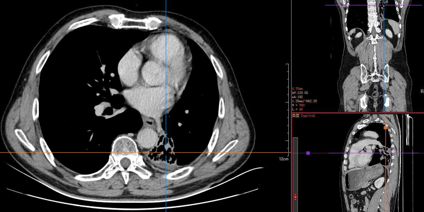 免疫治疗6次后肿瘤消失了,肺鳞癌中晚期化疗联合免疫治疗