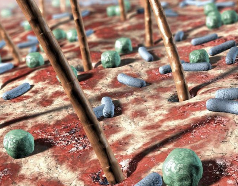 注射完后针眼溃烂怎么办,注射后针孔发炎怎么处理