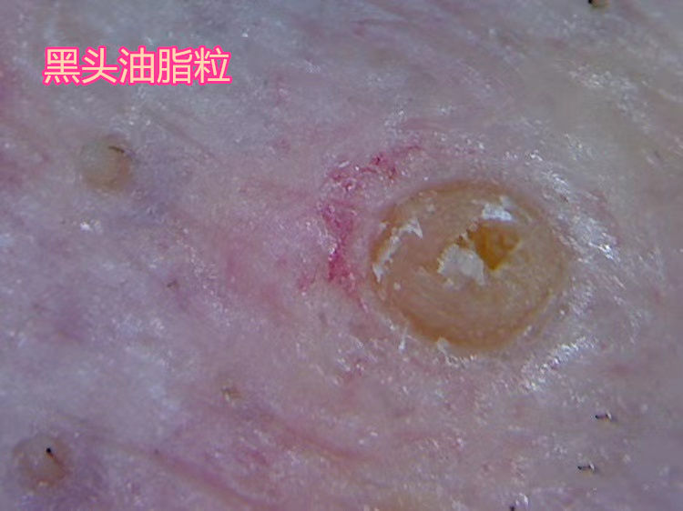 鼻头长黑粉刺怎么回事图片,鼻梁及两侧起了闭口粉刺