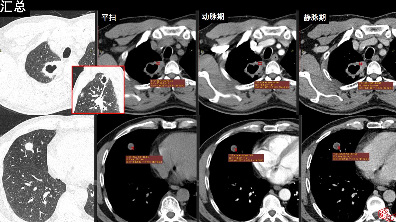 肉芽肿性血管炎ct表现,嗜酸性肉芽肿性血管炎症状