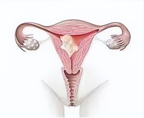 全国肿瘤防治宣传周原发性骨肿瘤,妇科肿瘤防控指南