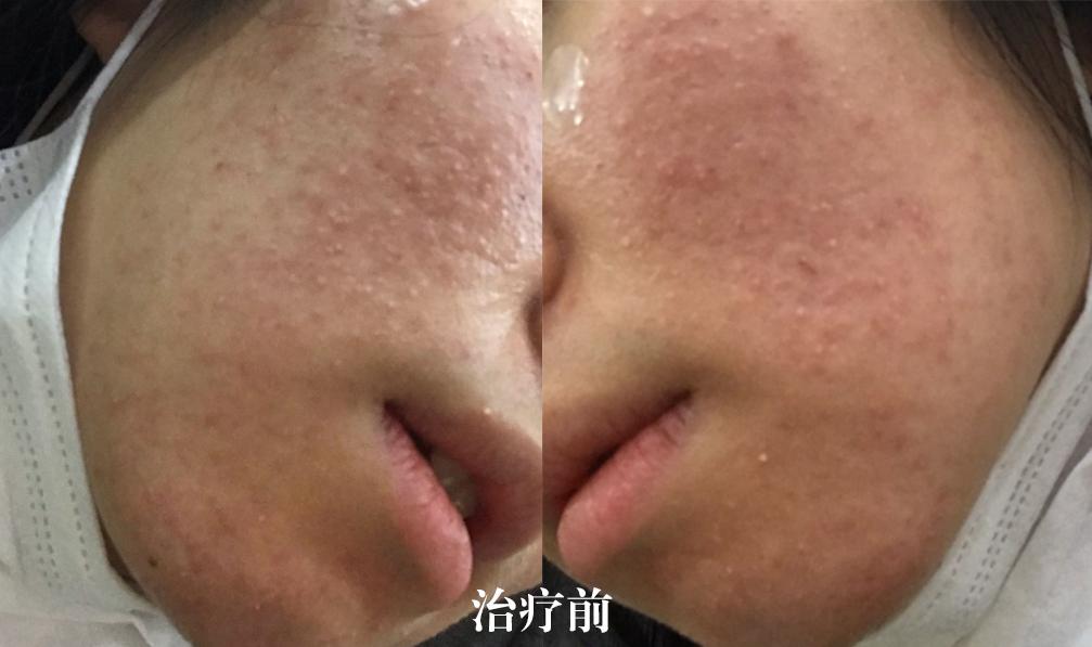 五年的痘坑能用生长因子吗,五年的痘印怎么祛除