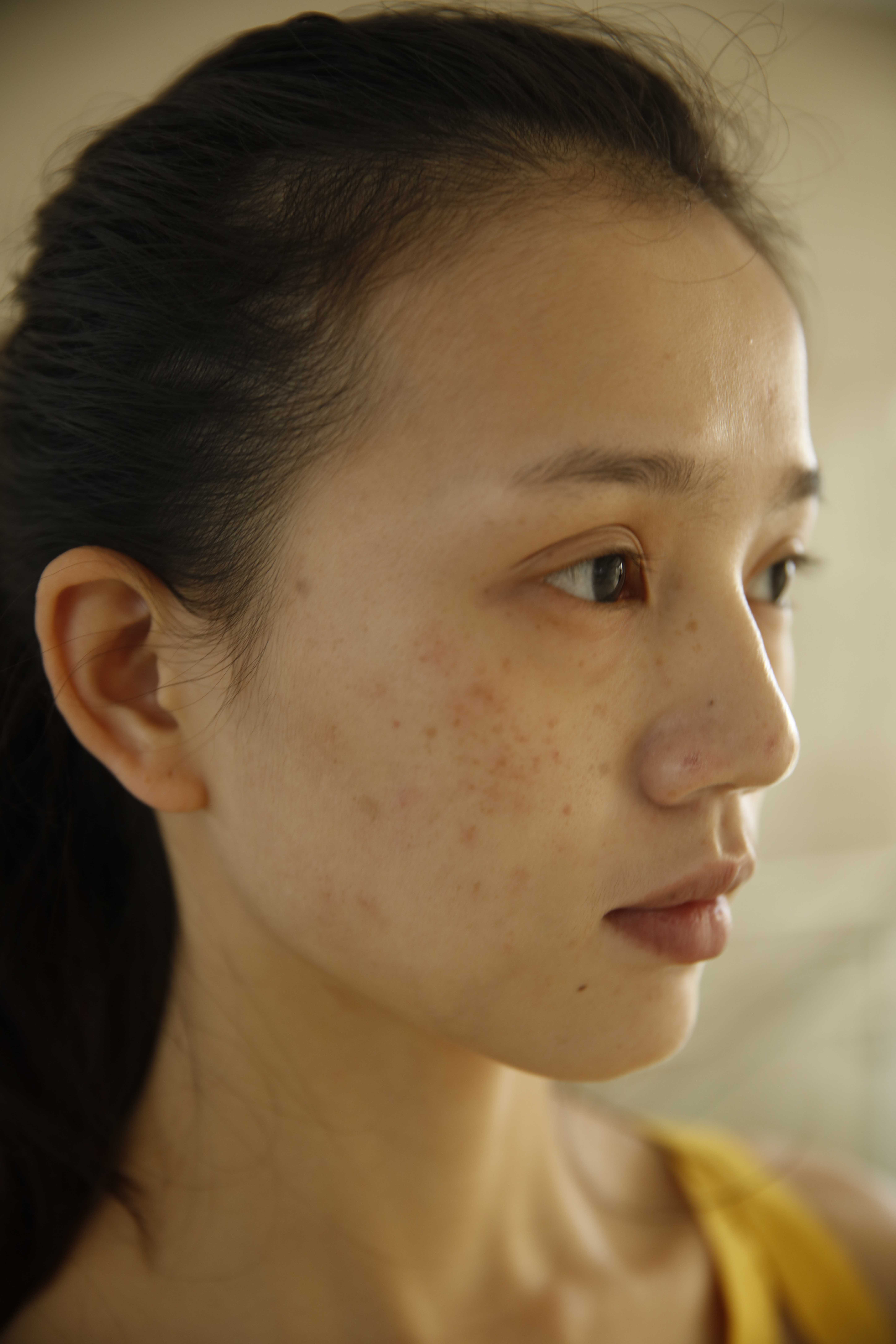 再漂亮的小姐姐也会被痘印困扰，治疗完后感叹激光治疗效果真不错