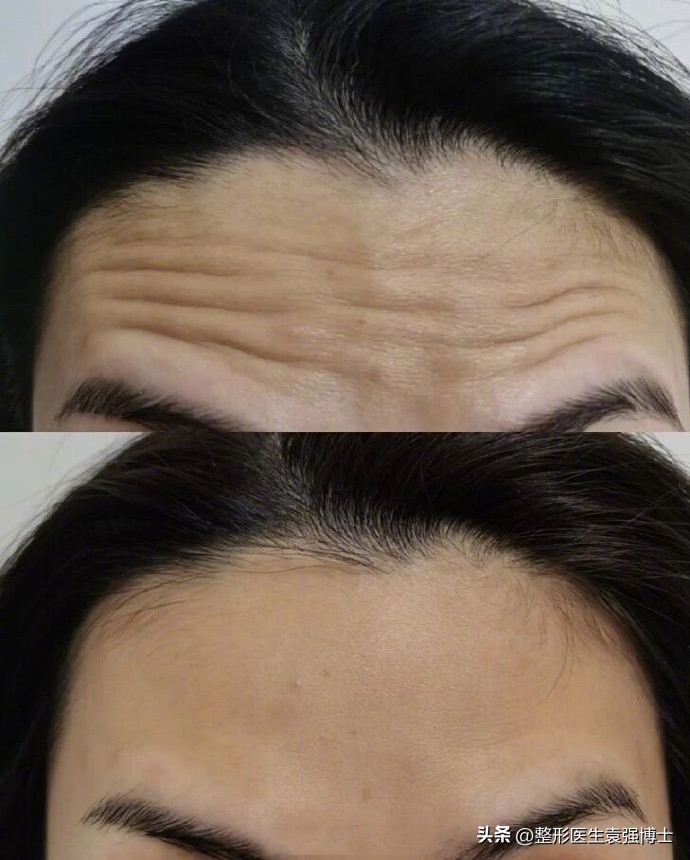 抬头纹影响运势图文,有抬头纹的人运势怎么化解