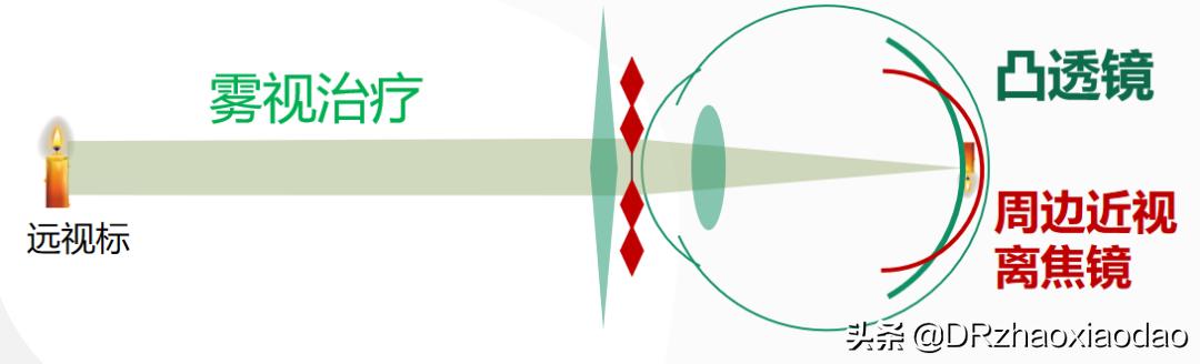 雾视治疗的最佳方法,雾视治疗是什么意思
