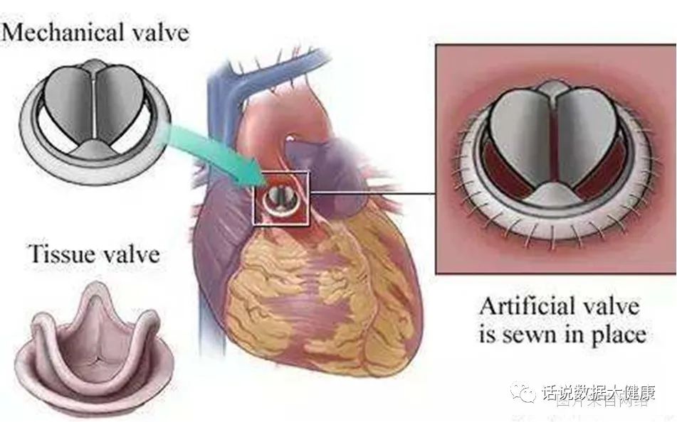 纳豆能预防心脑血管病吗,纳豆胶囊对于心血管狭窄有效吗