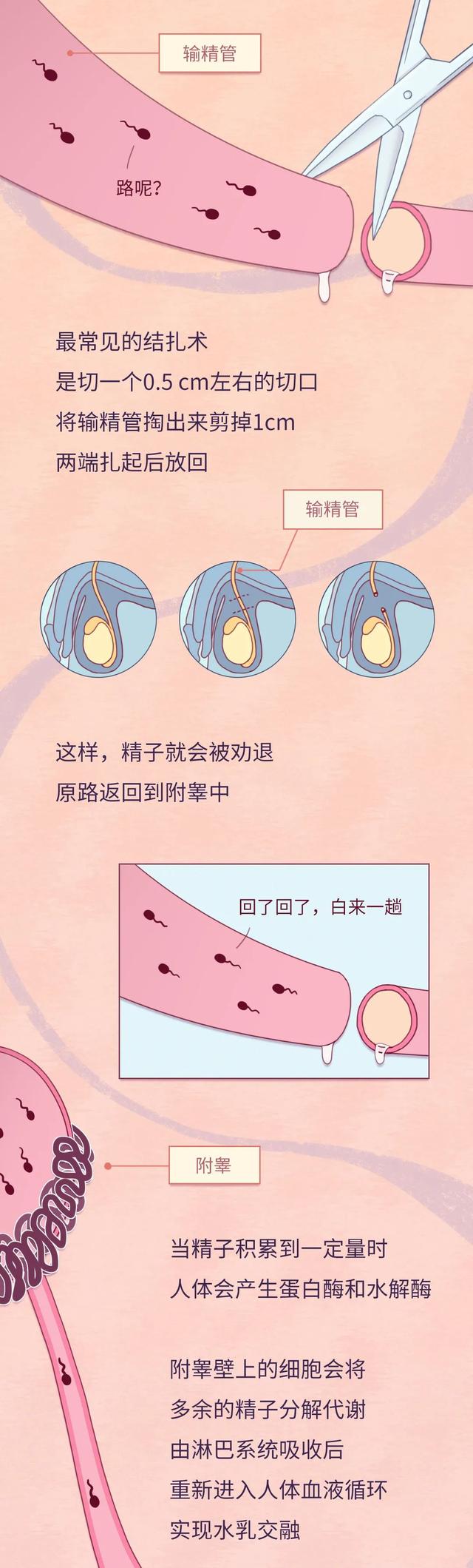 男性结扎后还能不能产生精子,男性结扎后还可以产生精子吗
