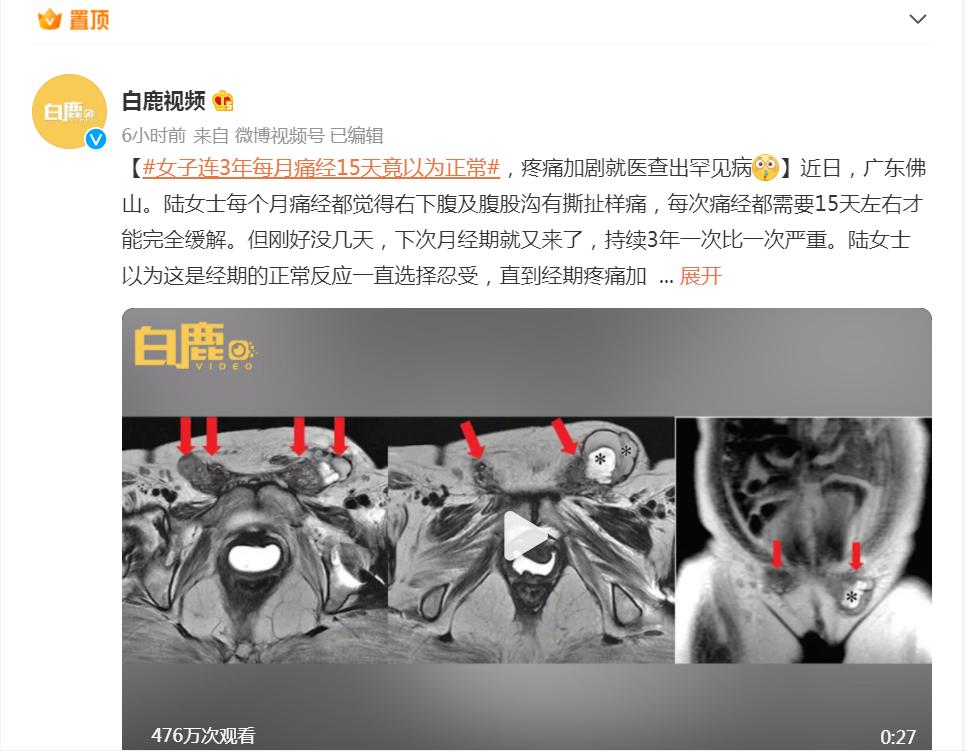 痛经非常严重一般得了什么病,女子连续三年痛经每月痛经15天