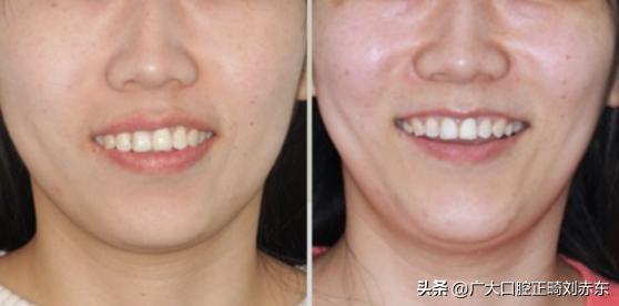 戴牙套可以改善牙齿歪吗,戴牙套可以改善脸歪嘴斜么