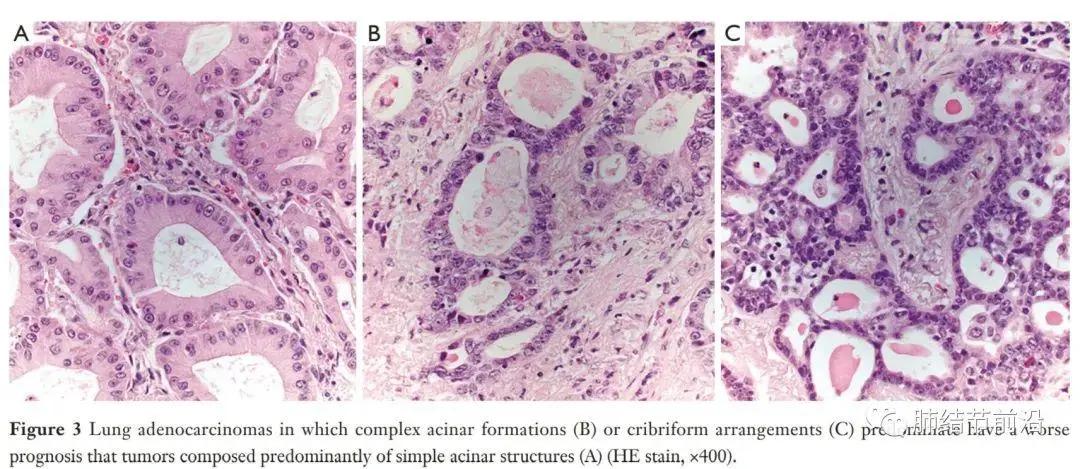 女性患者59岁发现颈部包块,脖子淋巴结有个疙瘩是肺癌转移吗