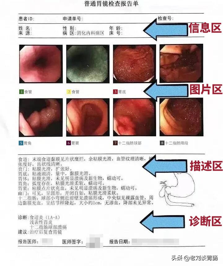怎么看懂胃镜报告,如何看懂胃镜报告单呢