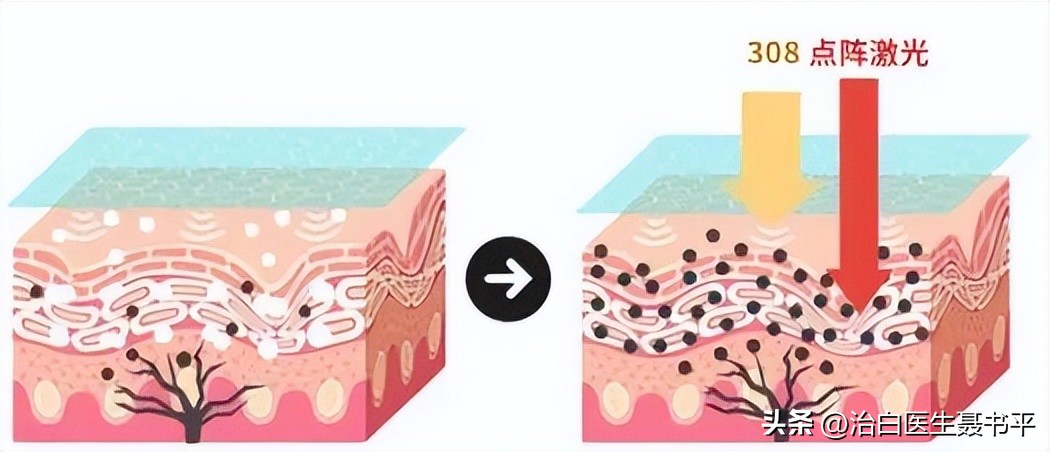 点阵激光疗法，打破白癜风治疗瓶颈