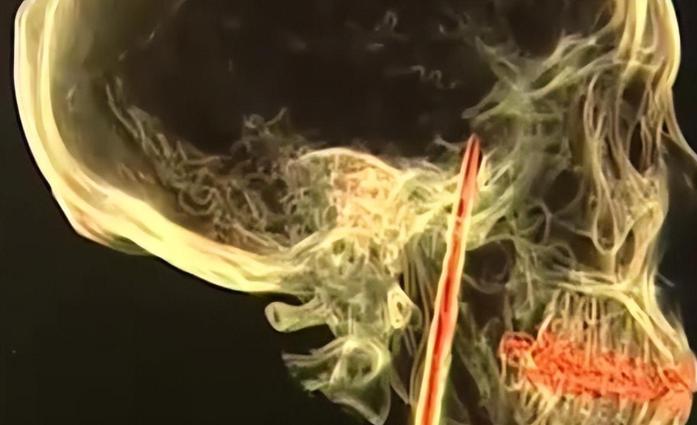 云南男子被妻子按摩到吐血，去医院检查，医生：你脑袋里插了把刀