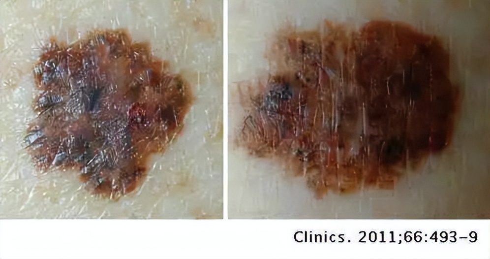 痣变黑变大是癌变了还是癌前病变,痣的病变到癌需要多长时间