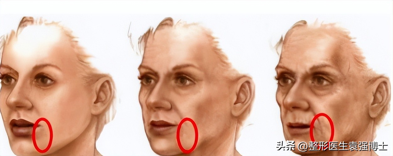 口角囊袋下垂怎么办,口角囊袋去掉会不会变松弛