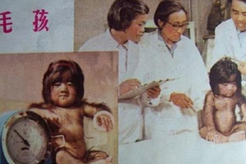 当年轰动一时的“毛孩”：42岁娶90后娇妻，生下一子未遗传长毛