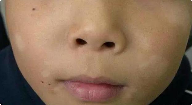 孩子脸上有白斑吃什么打虫药,小孩子脸上长白斑需要吃打虫药吗