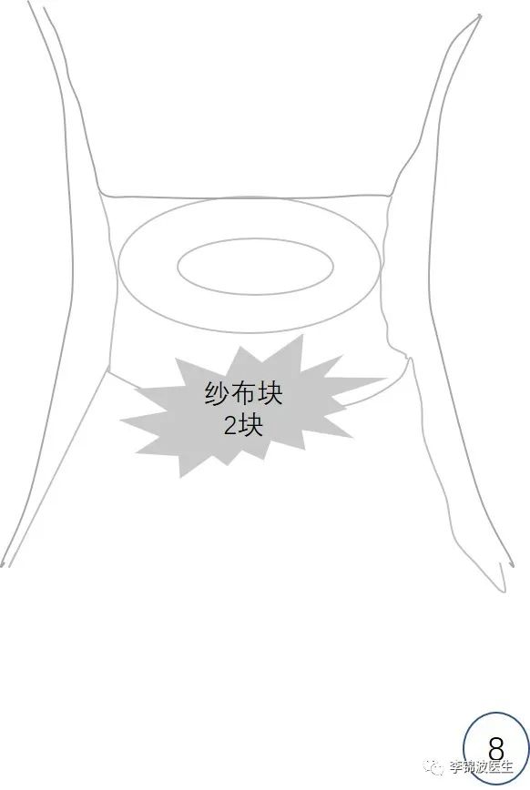 拆除高位宫颈环扎线的步骤和注意事项