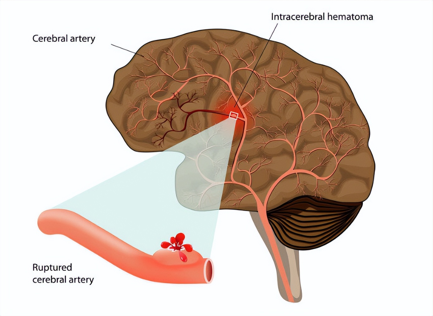 高血压轻微脑出血引起脚麻痹无力,高血压脑出血一侧身体麻木怎么办