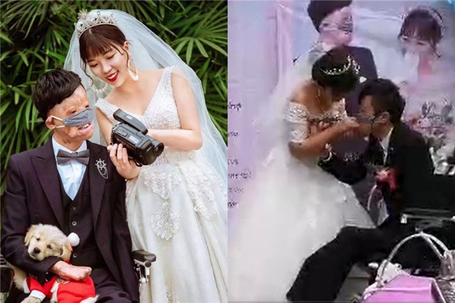 新郎救火时毁容新娘依然嫁给了他,新郎被烧伤新娘前往医院