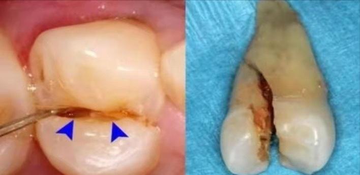 根管治疗后牙齿一直不舒服,根管治疗后牙齿需要全冠吗