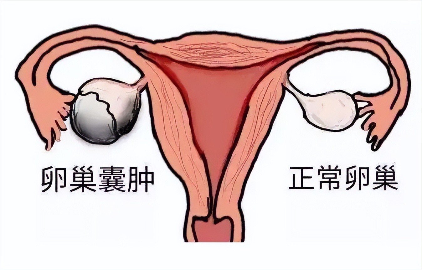 卵巢囊肿痛经不规则出血,卵巢囊肿痛经吃什么药比较好