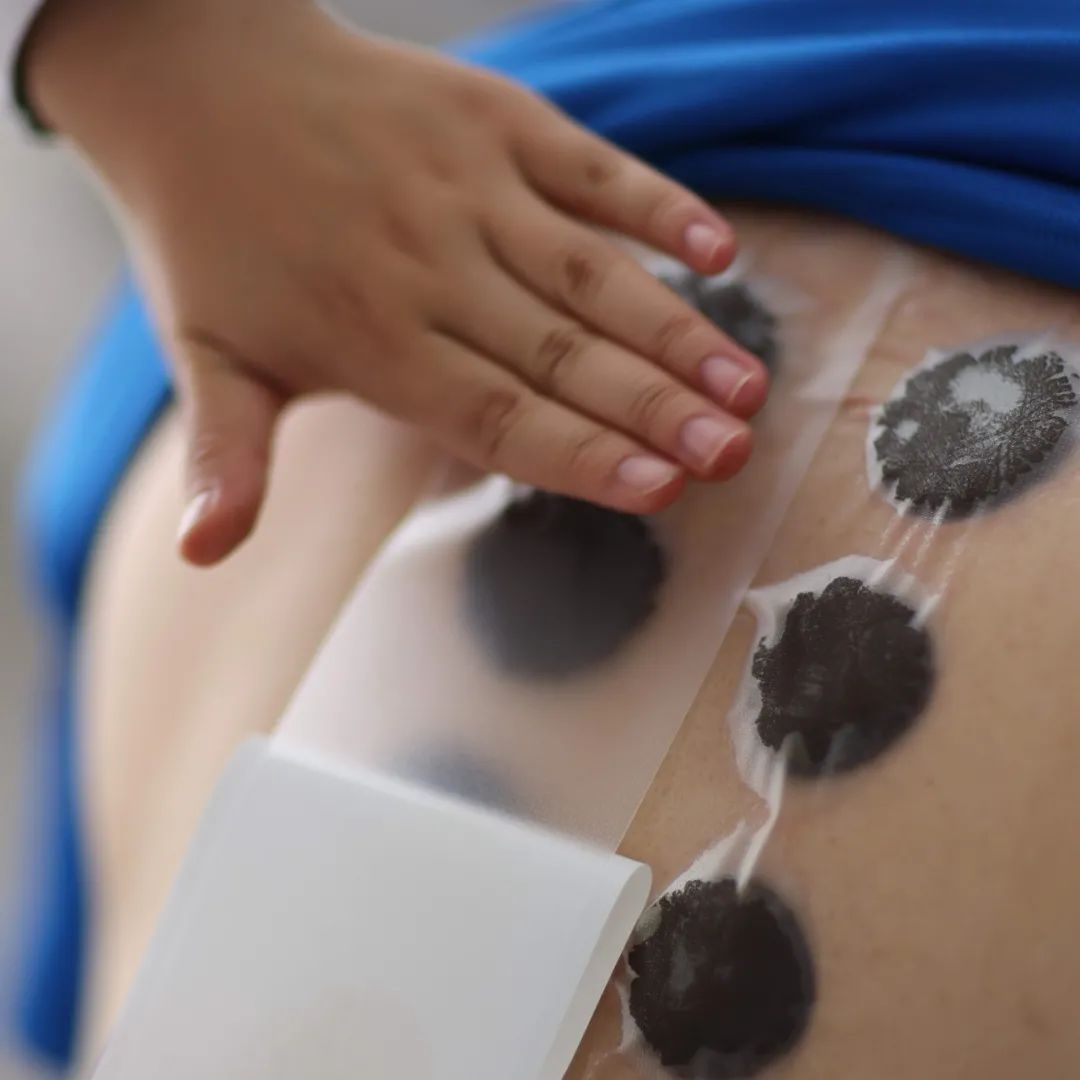 广安门医院消喘膏,消喘膏贴敷疗法