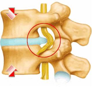 中医治疗椎间盘突出怎么治疗,温通针法治疗椎间盘突出