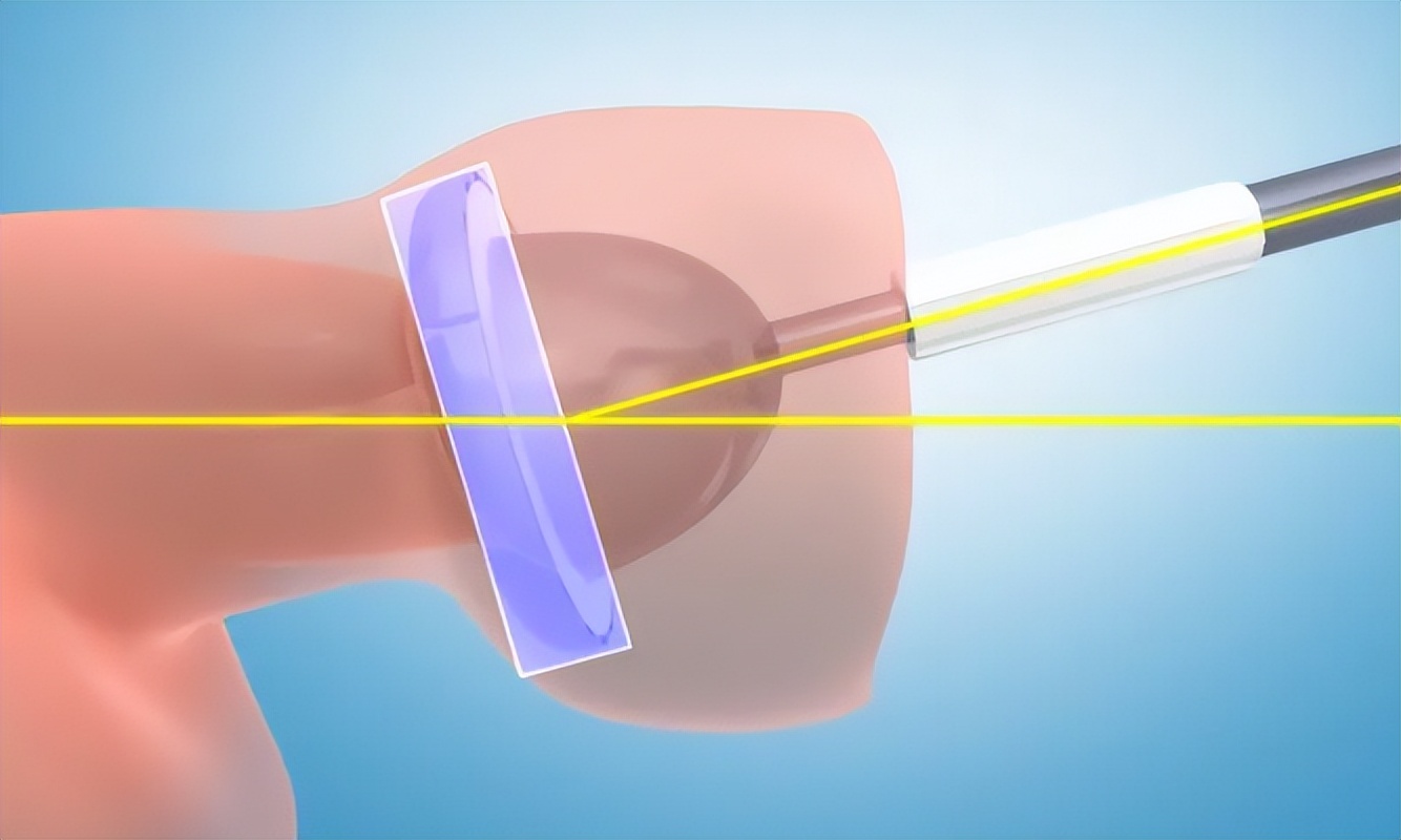 90多岁阴茎癌需要手术吗,男性阴茎癌手术后能活多久