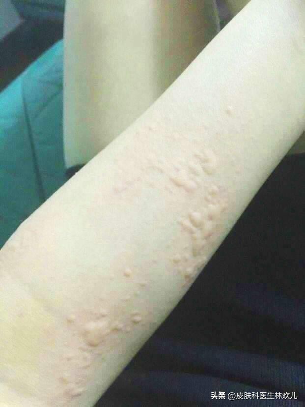 新冠期间皮肤瘙痒红斑咋回事,新冠皮肤痒怎么回事