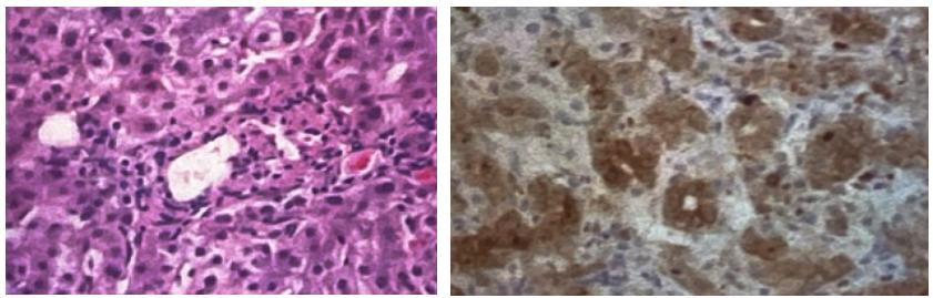 胆管消失综合征是重大疾病吗,胆管消失肝损伤能治愈吗