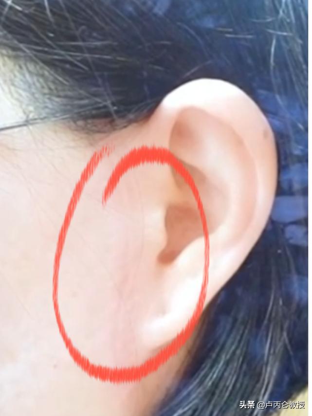 做拉皮除皱手术后遗症,拉皮除皱手术有哪些风险和后遗症